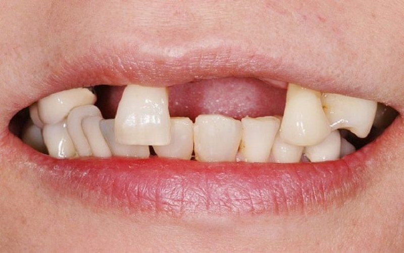 Giải mã: Mơ thấy rụng răng hàm trên điềm báo điều gì?
